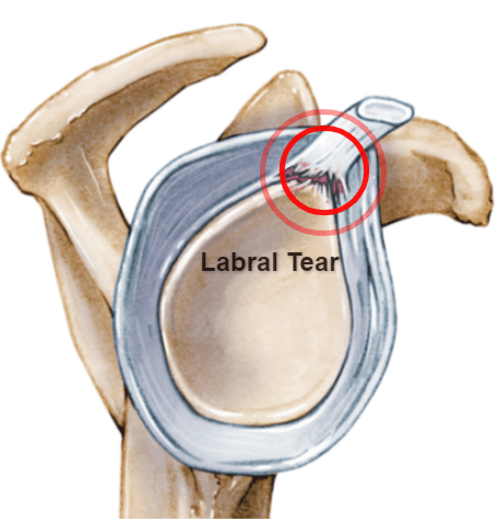Illustration of tear at top portion of shoulder labrum tissue